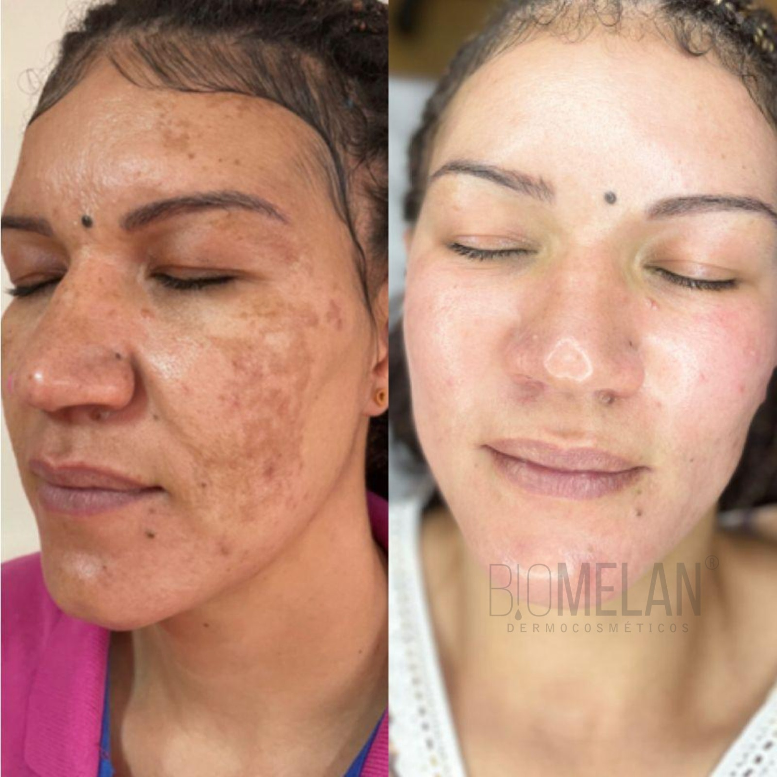 Resultado de tratamento de melasma em Indaiatuba — paciente caso 01, antes e depois