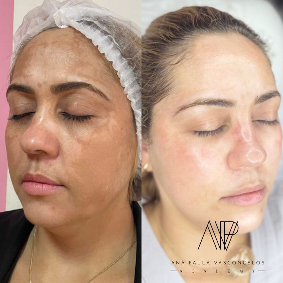 Resultado de tratamento de melasma em Indaiatuba — paciente caso 02, antes e depois