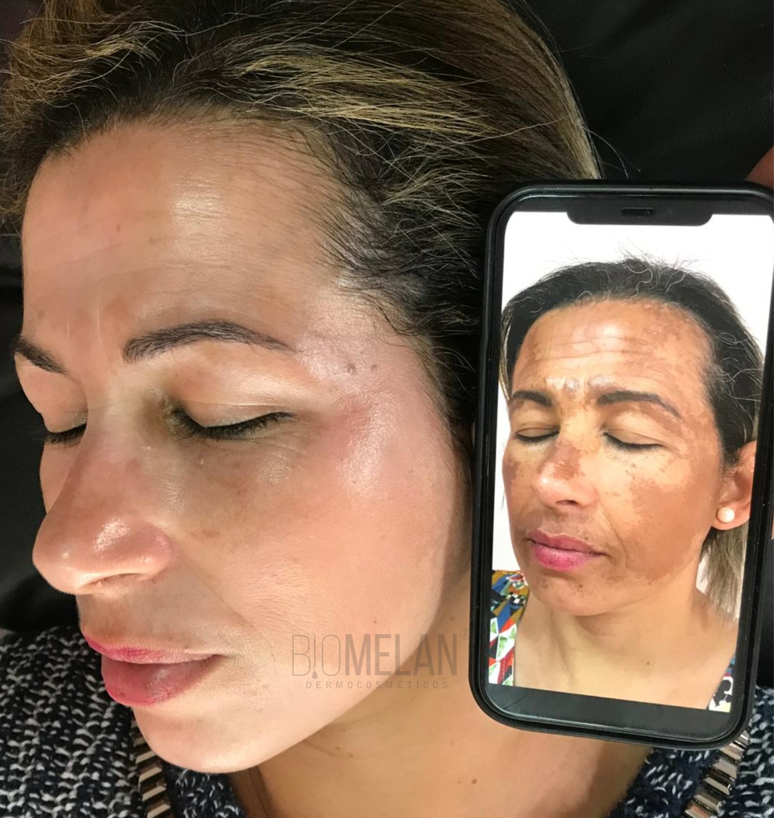 Resultado de tratamento de melasma em Campinas — paciente caso 03, antes e depois