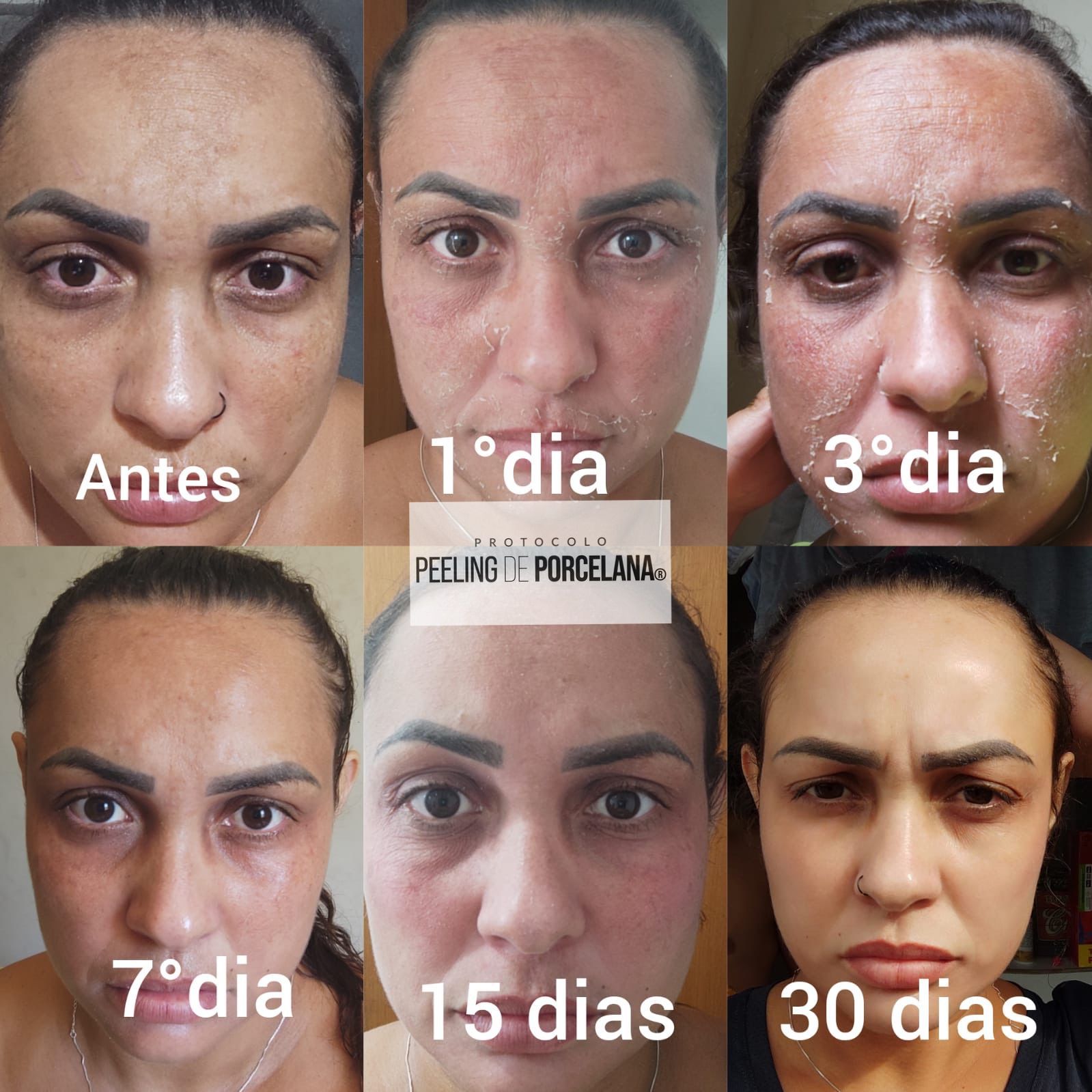 Resultado de tratamento de melasma em Campinas — paciente caso 04, antes e depois